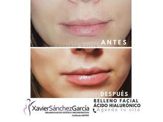 Antes y después de Aumento de labios