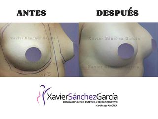 Antes y después de Aumento de busto