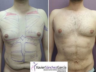 Antes y después de lipo vaser 