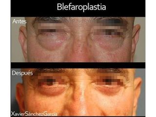 Antes y después de Blefaroplastia