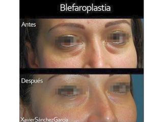 Antes y después de Blefaroplastia