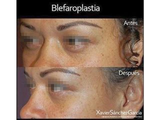 Antes y después de Blefaroplastia