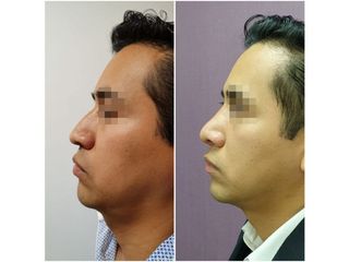 Antes y después de Rinoplastia