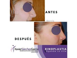 Antes y después de Rinoplastia