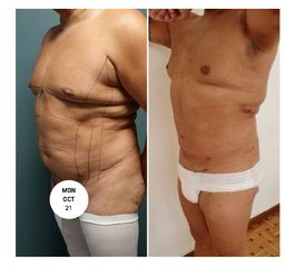 Antes y después de Liposucción Vaser