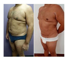 Antes y después de Liposucción Vaser