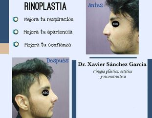 Antes y después de Rinoplastia