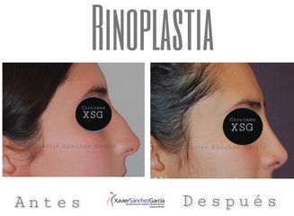 Antes y después de Rinoplastia