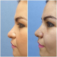 Antes y después de Rinoplastia 