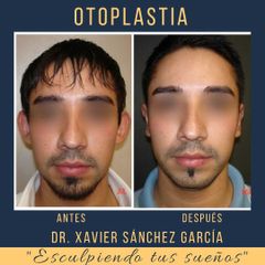 Antes y después de Rinoplastia