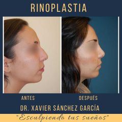 Antes y después de Rinoplastia