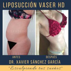 Antes y después de Lipoescultura