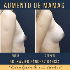 Antes y después de Aumento de busto