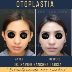 Antes y después de Otoplastia