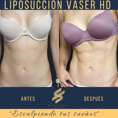 Antes y después de Liposucción Vaser