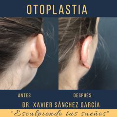 Antes y después de Otoplastia