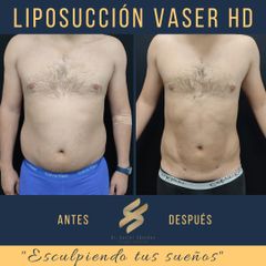 Antes y después de Liposucción Vaser 