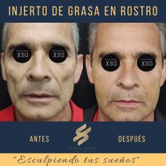 Antes y después de Tratamientos faciales