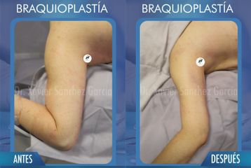 Braquioplastia - Dr. Xavier Sánchez García