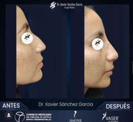 Rinoplastia - Dr. Xavier Sánchez García