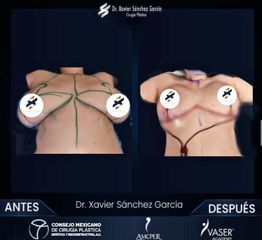 Reducción mamas - Dr. Xavier Sánchez García