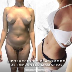 Lipoescultura y recambio de implantes mamarios - Dr. Rodrigo Camacho Acosta