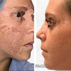 Laser facial  - Dr. Rodrigo Camacho Acosta