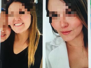 Antes y después de Liposucción de cuello + Bichectomia 