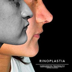 Rinoplastia - Dr. Rodrigo Camacho Acosta