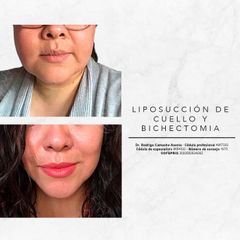 Antes y después de Bichectomia y lipopapada