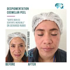 Cosmelan Peel - Dr. Gerardo Rubio