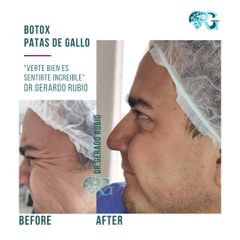 Bótox Orbiculares - Dr. Gerardo Rubio