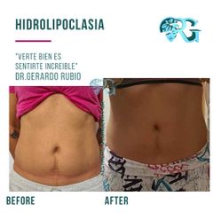 Hidrolipoclasia + Cavitación - Dr. Gerardo Rubio