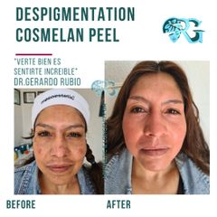 Cosmelan Peel - Dr. Gerardo Rubio