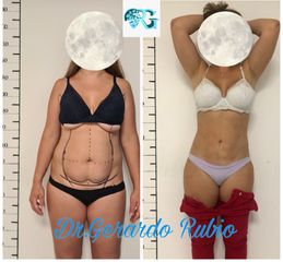 Mini Lipoescultura - Dr. Gerardo Rubio