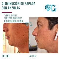 Enzimas Lipoliticas en Papada - Dr. Gerardo Rubio