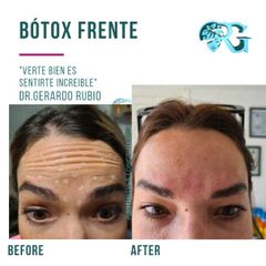 Bótox Frente - Dr. Gerardo Rubio