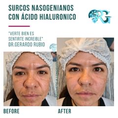 Ácido Hialurónico en Surcos Nasogenianos