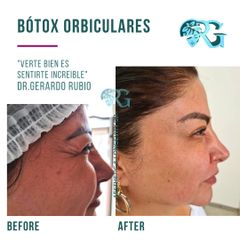 Bótox Orbiculares o Patas de Gallo