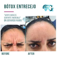 Limpieza Facial Mecánica