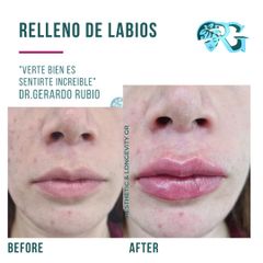 Relleno de Labios