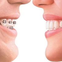 Brackets: La revolución de la ortodoncia invisible
