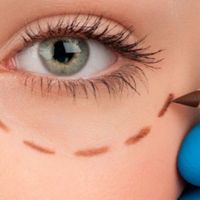 Blefaroplastia evolutiva, la técnica que mejora la mirada