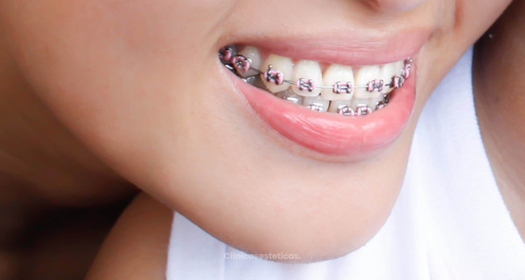Un incorrecto tratamiento de brackets puede dañar nuestros dientes