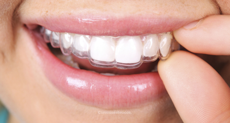Invisalign y la ortodoncia removible invisible
