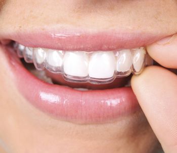 Invisalign y la ortodoncia removible invisible