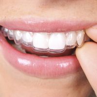 Invisalign y la ortodoncia removible invisible