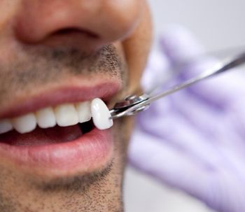 Carillas de porcelana, el secreto de una sonrisa perfecta
