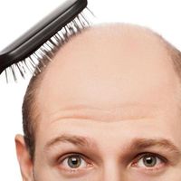 ¿Qué tipo de alopecia tienes?
