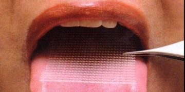 La malla lingual, un nuevo tratamiento polémico para perder peso